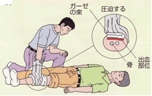 出血時の止血法02